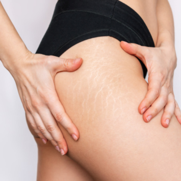 Cicatrices y estrías-Centre d'estètica Mayka