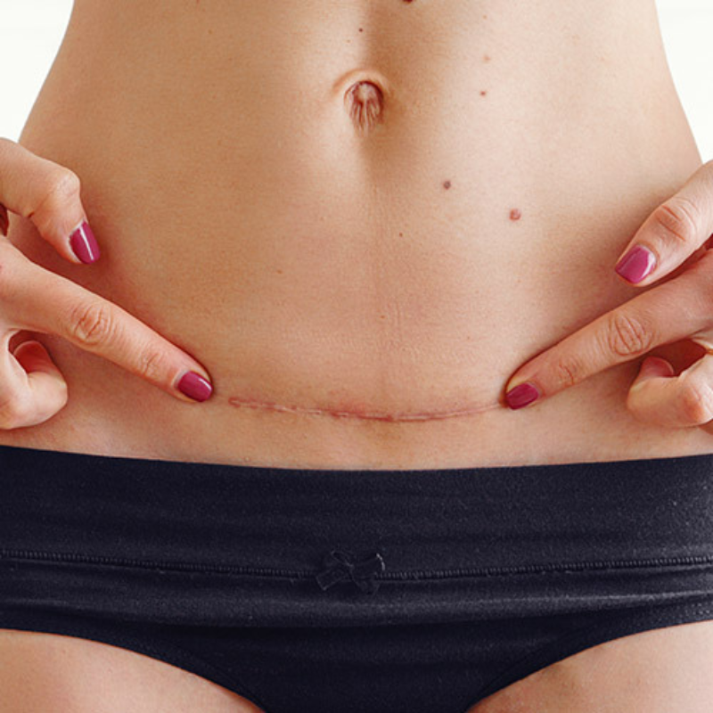 CICATRICES Y ESTRIAS CICATRICES Y ESTRIAS